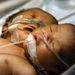 Fülöp-szigetek: Kétfejű kislány született a manilai kórházban