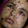 Rawya abu Joma egy légi csapásban sérült meg, a 17 éves palesztin lány arcát törmelék okozta sérülések borítják.